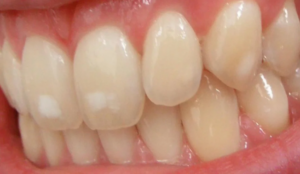 macchiette bianche sui denti