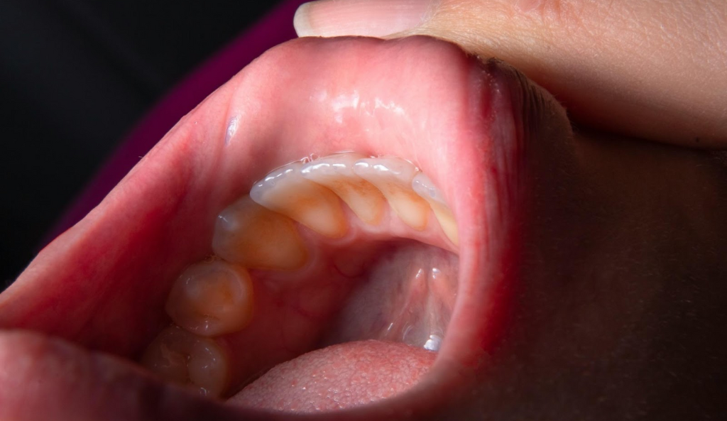 Sintomi tumore alla bocca: riconoscere i segnali dall’allarme per una diagnosi precoce