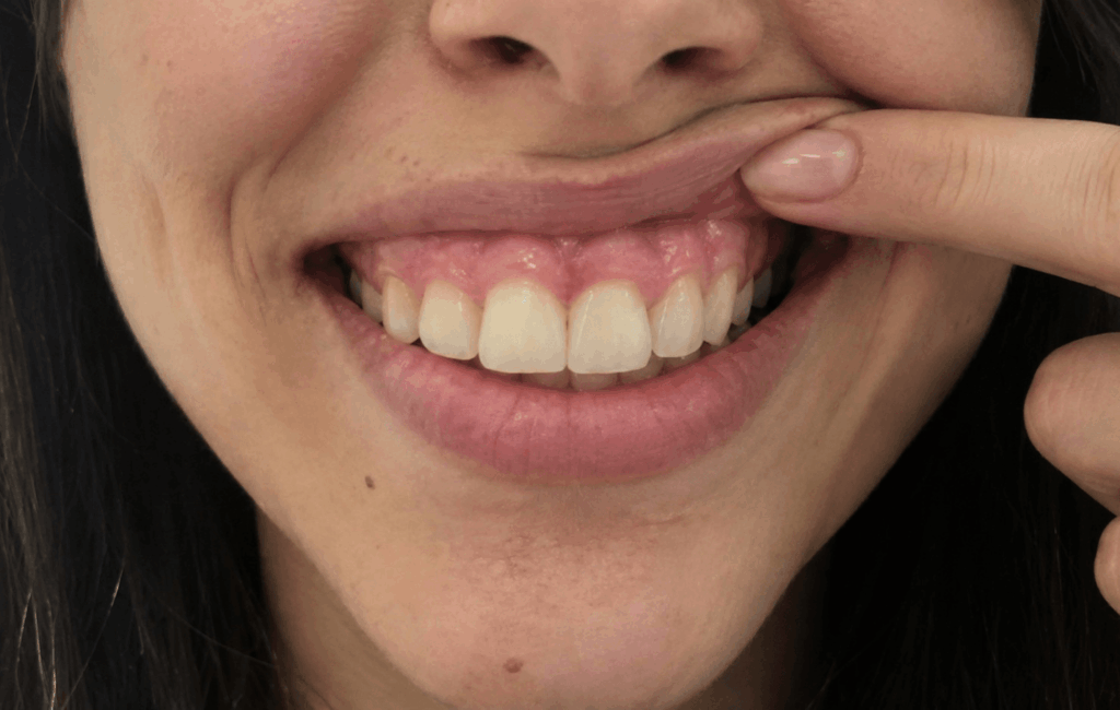 Gummy smile: cos'è il sorriso gengivale e come si corregge